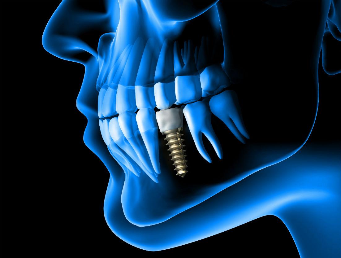 Dental Implants Sugar Land, TX